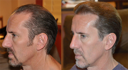 California Hair Restoration For Hair Loss