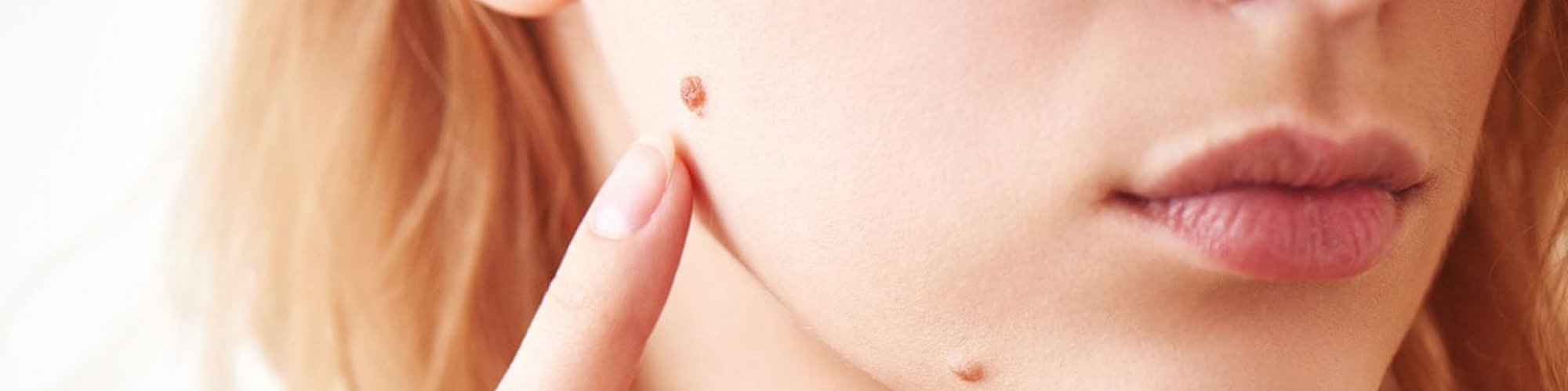 Skin Tag Removal Singapore Look for The Help Of An Expert